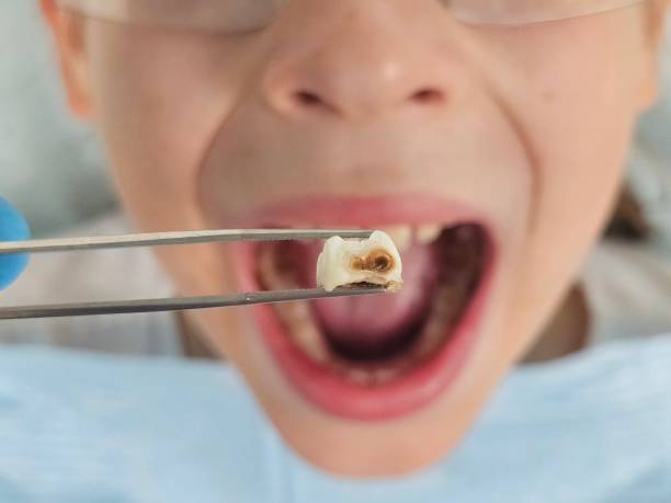 Best Emergency Broken Tooth Repair in Strathmore, NJ